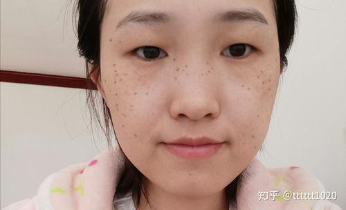 激光祛斑的过程视频